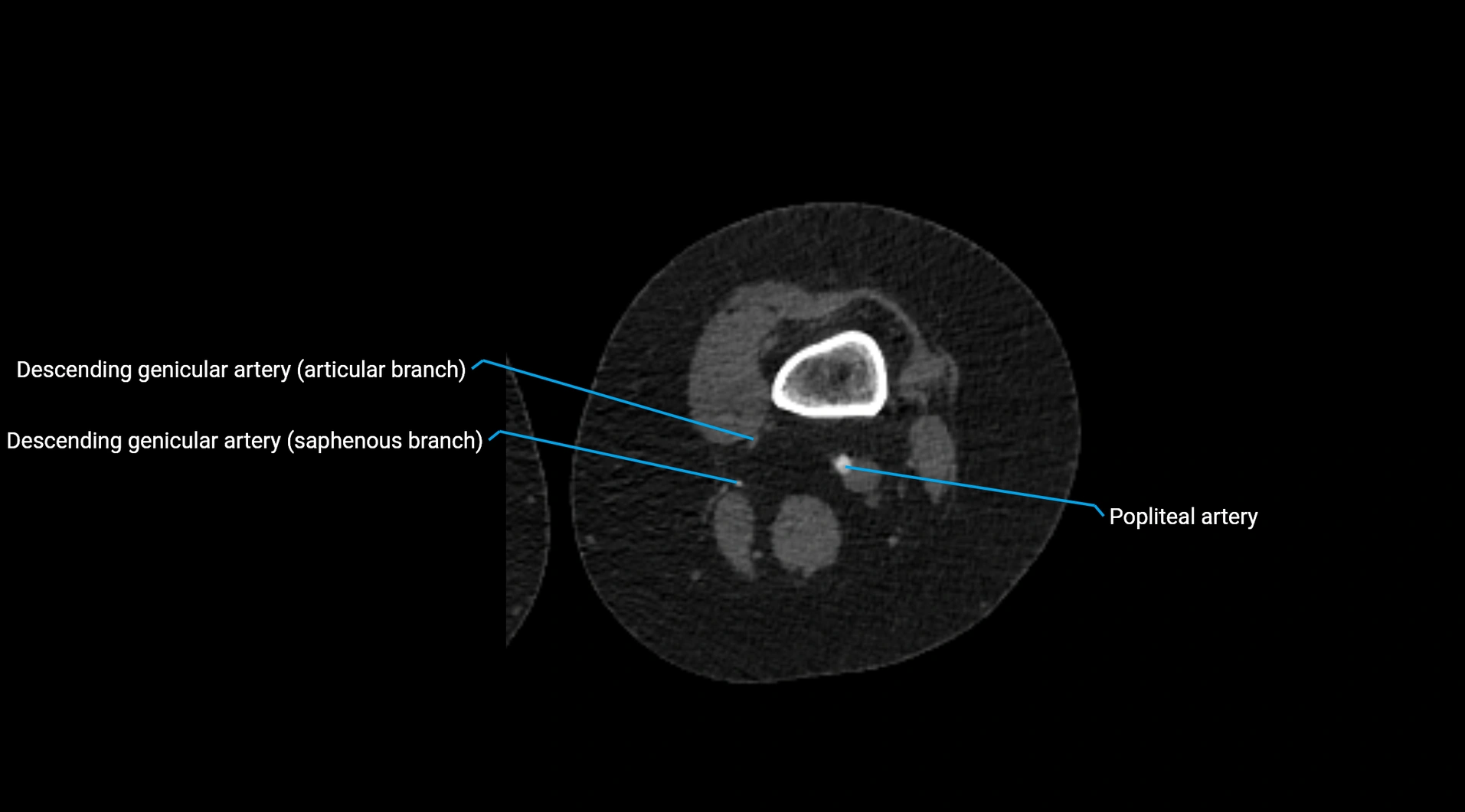CTA lower limb cross sectional anatomy labelled image _161.webp